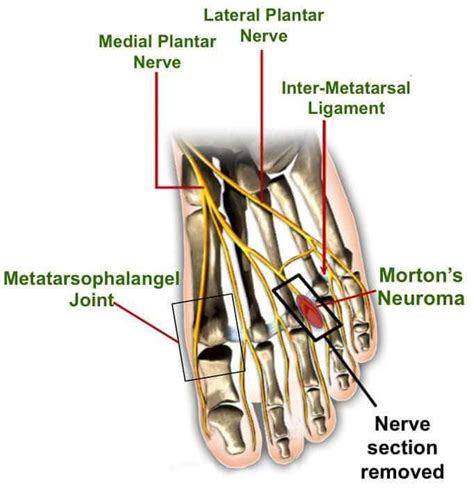 What Causes Metatarsophalangeal Mtp Joint Pain