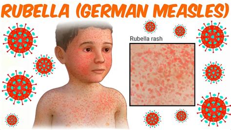 Rubella German Measles Youtube