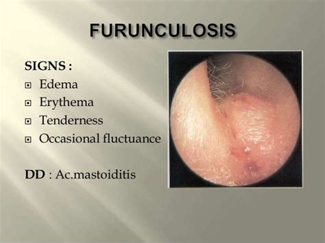 Diseases Of External Eardrsgopalakrishnan 130617