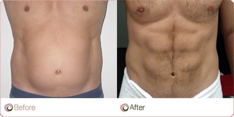 The Types Of Liposuction Cost Weight Loss Surgery
