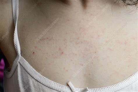 Eczema On A Childs Chest Stock Image C0215597 Science Photo Library