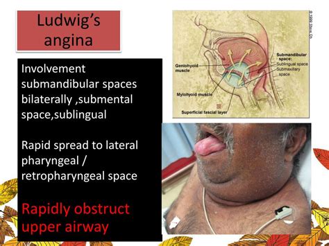 Ppt Odontogenic Infection In Maxillofacial Region Powerpoint