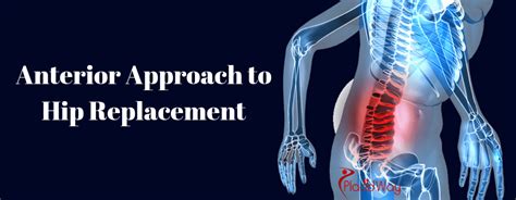 Anterior Approach To Hip Replacement