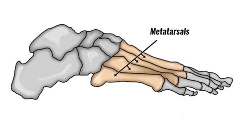 Metatarsal Stress Fracture Symptoms Causes And Treatment