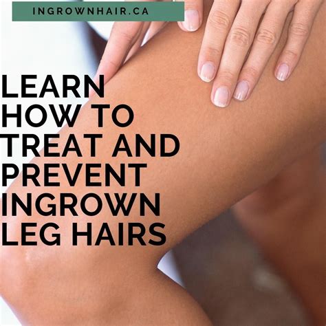 Learn How To Prevent And Treat Ingrown Hairs With A Few Tips From Our Blog Posts Shaving