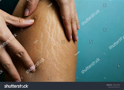 Stretch Marks On Womans Legs Female Stock Photo Edit Now 1708104286