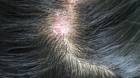 Pimples And Scabs On The Head Cause Dr Piotr Turkowski