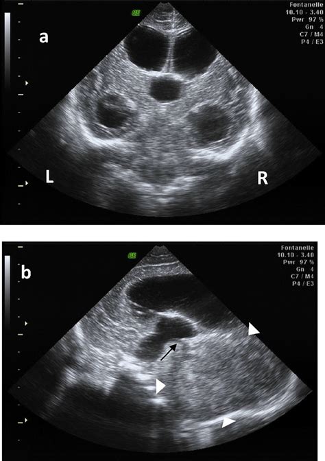 Sonographic Image A In Coronal View Demonstrates With Bilateral