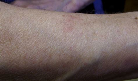 Bed Bug Rash On Arm Bangdodo