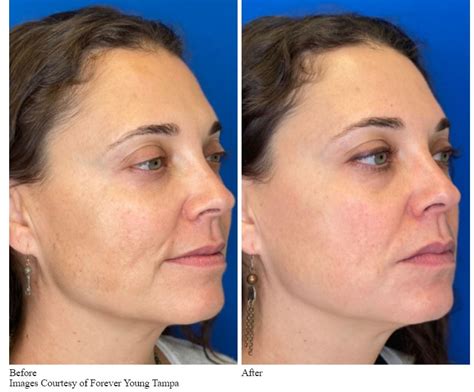 virtue radiofrequency microneedling a breakthrough in skin care medical spa