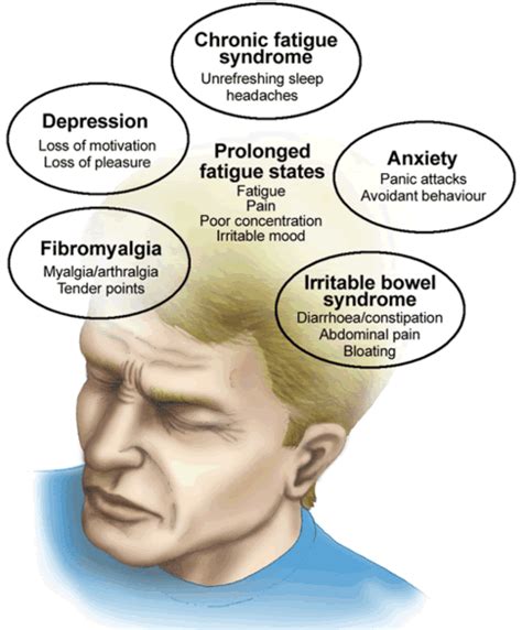 Emerson Villela Carvalho Jr., M.D.: Chronic fatigue syndrome renamed ...