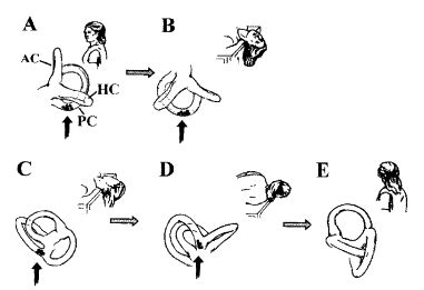 View Modified Epley Maneuver Pdf Backenreesz