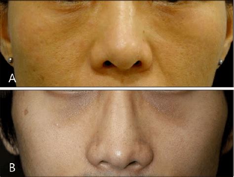 How To Get Rid Of Skin Pigmentation Around Eyes