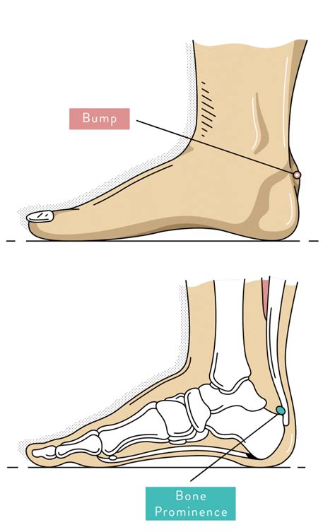Heel Pain Causes Types And Podiatry Treatment