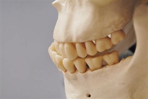 Misaligned Jaw Causes Complications And Treatments