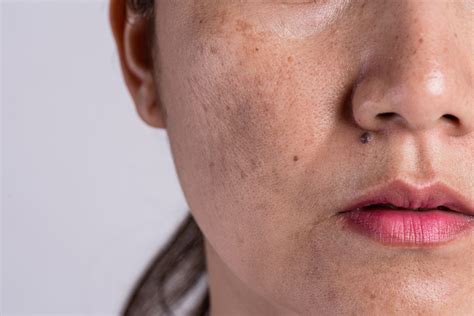Hyperpigmentation What Causes Skin Discoloration The Healthy