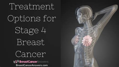 What Are The Treatment Options For Stage Breast Cancer Youtube