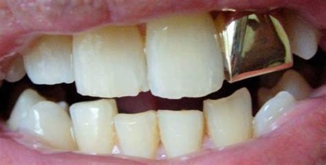Qué Es Una Corona Dental Tipos Y Precios De Fundas Dentales