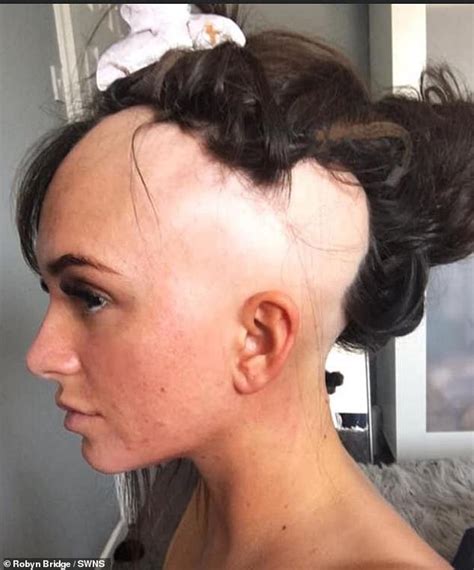 Alopecia Sufferer 27 Sick Of Struggling To Cover Up Her Bald Patches Shaves Head Completely