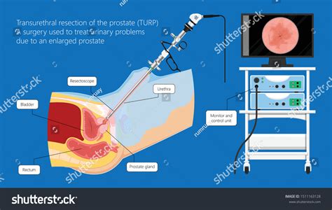 Transurethral Resection Prostate Stricture Urine Bladder Vector có sẵn miễn phí bản quyền