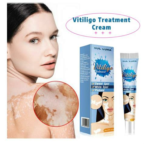 20g Herbal Extract Vitiligo Ointment Vitiligo Skin Psoriasis
