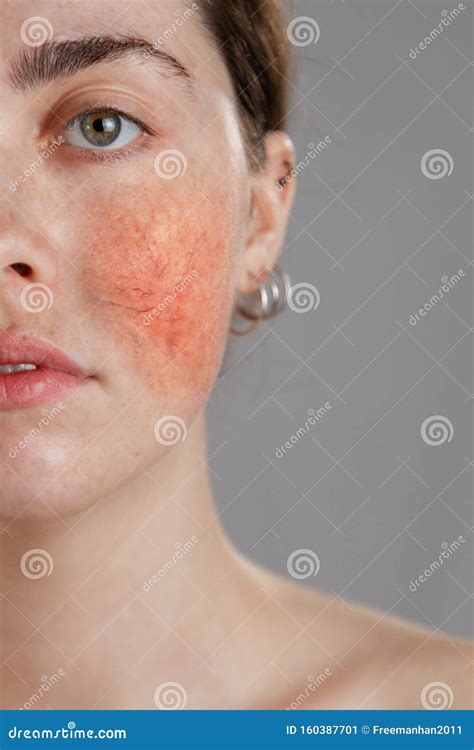 Cosmetology And Rosacea Close Up Portrait Of Female Face Cheeks With
