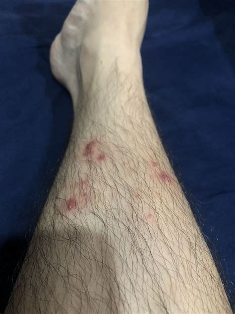 Herpes On Lower Legs Help Needed General Herpes Discussion H Opp