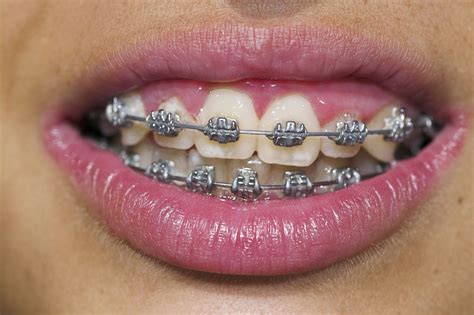 Braces Colors That Make Teeth Whiter