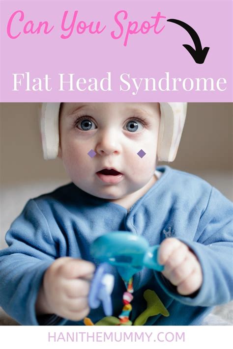 Can You Spot Flat Head Syndrome Lose Baby Weight Flat Head Baby
