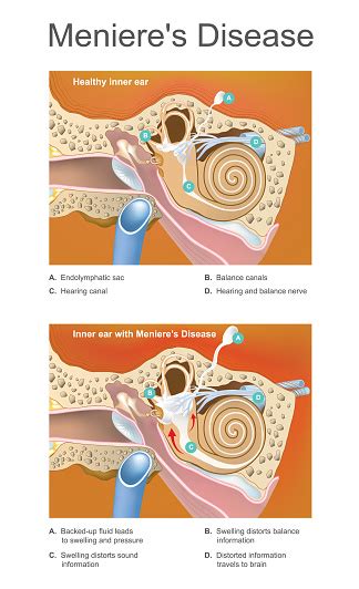 Meniere Disease Illustration Disorder Of The Inner Ear That Can Effect