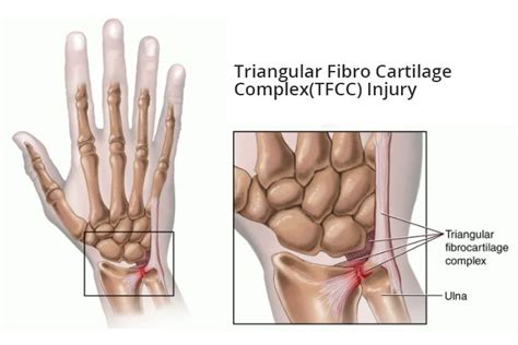 Triangular Fibrocartilage Complex Tfcc Tear