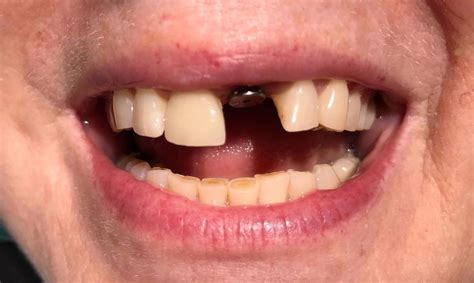 Dunwell Dentistrys Smile Gallery Implant Restoration Of Missing Tooth