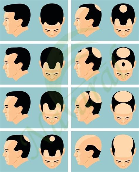 How To Know If Youre Going Bald Know What Stage Are You In 2020