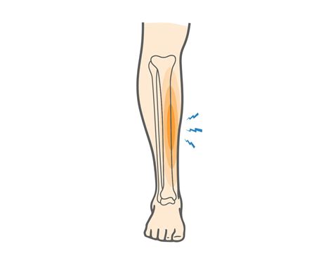 What Is Shin Splints Its Symptoms Causes And Risk Factors Home