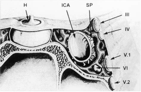 Figure 1 From Anatomy Of The Orbital Apex And Cavernous Sinus On High