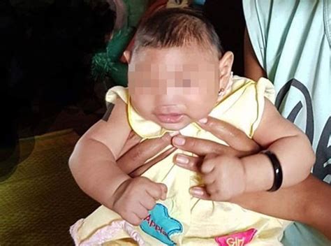 Vn Confirms First Zika Tied Birth Defect Case