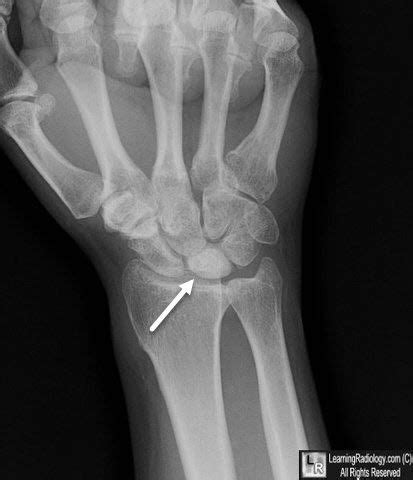 Avascular Necrosis Of Lunate Bone Avascular Avascular Necrosis