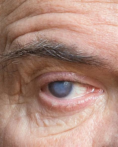 What Is A Cataract Cataract Surgeons Houston Eye Center Of Texas