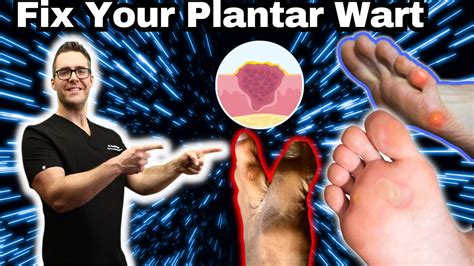 Plantar Warts Removal At Home Treatment Foot And Toe Wart Remedies Youtube