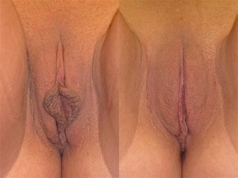 Labiaplasty Before And After Pictures Case Naples And Ft Myers Fl Kent V Hasen Md
