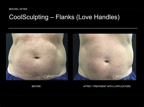 Before And After Photos Of Coolsculpting Treatment Results
