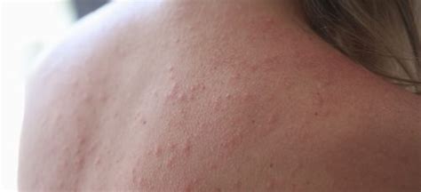 Skin Disease Of The Week Polymorphic Light Eruption Elect Dermatology