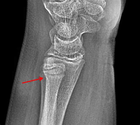 Distal Radial Metaphysis Fracture