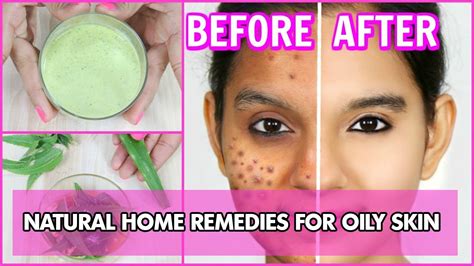 Oily Skin How To Get Rid Of Oily Skin Oily Skin Causes Youtube