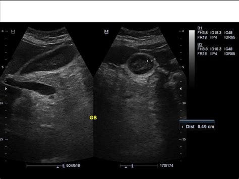 Lupus Nephritis Echocardiography Or Ultrasound Wikidoc