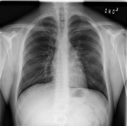 Feature extraction methods like dwt, wft, and wpt can also be used. Pneumonia detection from chest radiograph using deep ...