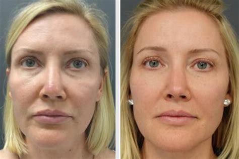 Stem Cell Lift Facelift Dr Newman Beverly Hills Face Lift