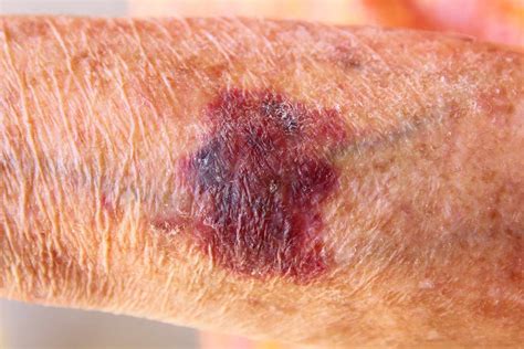 Eczema Types Of Bruises