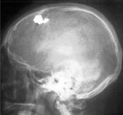Shrapnel Injury To Skull Download Scientific Diagram