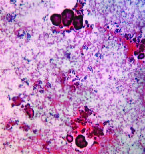 Ascitic Fluid Cytology Showing Cohesive Clusters And Papillary